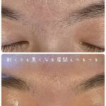 美容電気脱毛眉間