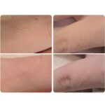 美容電気脱毛手の指