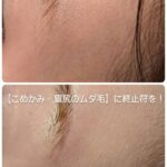 美容電気脱毛こめかみ