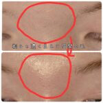 美容電気脱毛眉間