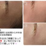 美容電気脱毛顔脱毛