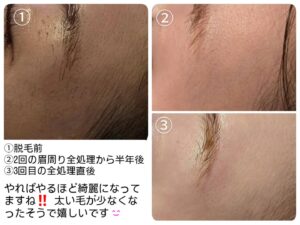 美容電気脱毛顔脱毛