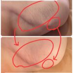 美容電気脱毛肩硬毛化