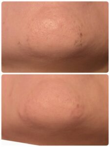 美容電気脱毛女性顎