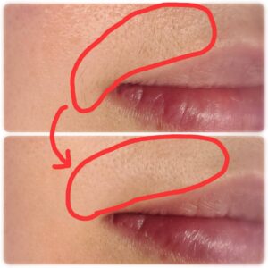 美容電気脱毛鼻下