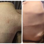 美容電気脱毛硬毛化背中