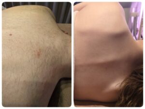 美容電気脱毛硬毛化背中