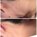 美容電気脱毛硬毛化襟足