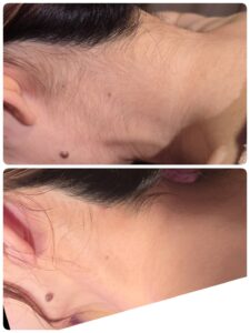 美容電気脱毛硬毛化襟足