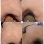 美容電気脱毛硬毛化背中