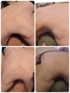 美容電気脱毛硬毛化背中