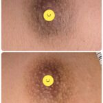 美容電気脱毛男性乳輪