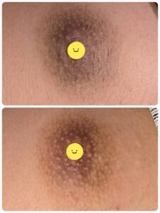 美容電気脱毛男性乳輪