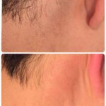 美容電気脱毛硬毛化襟足