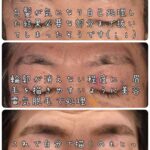 美容電気脱毛眉周り