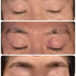 美容電気脱毛眉周り