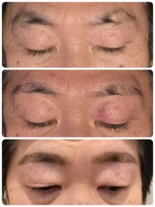 美容電気脱毛眉周り