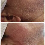 美容電気脱毛白髪髭