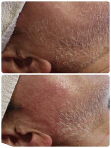 美容電気脱毛白髪髭