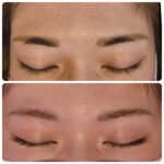 美容電気脱毛間引き