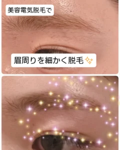 美容電気脱毛眉周り