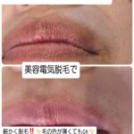 美容電気脱毛口周り産毛