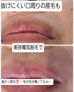 美容電気脱毛口周り産毛