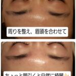 美容電気脱毛眉回り