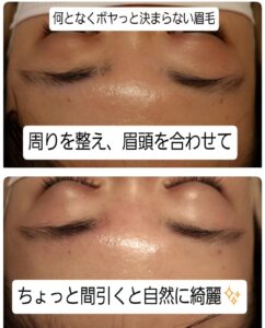 美容電気脱毛眉回り