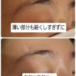 美容電気脱毛眉回り