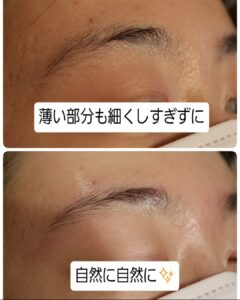 美容電気脱毛眉回り