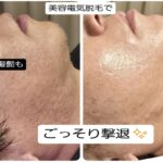 美容電気脱毛白髪髭