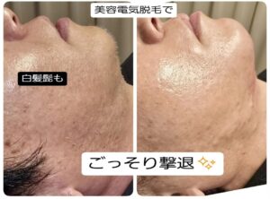 美容電気脱毛白髪髭