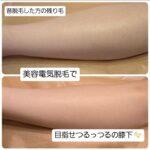 美容電気脱毛ひざ下残り毛