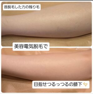 美容電気脱毛ひざ下残り毛