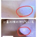 美容電気脱毛小鼻横の産毛