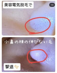 美容電気脱毛小鼻横の産毛