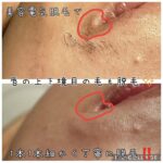 美容電気脱毛口周り