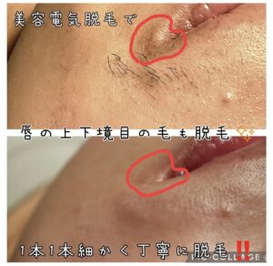 美容電気脱毛口周り