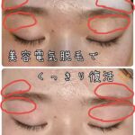 美容電気脱毛眉周り