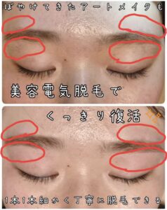 美容電気脱毛眉周り
