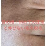 美容電気脱毛目の横産毛
