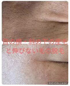 美容電気脱毛目の横産毛
