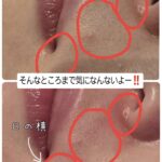 美容電気脱毛鼻下